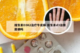 维生素D3K2治疗牛皮癣 维生素d3治银屑病吗