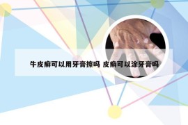 牛皮癣可以用牙膏擦吗 皮癣可以涂牙膏吗