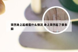 突然身上起癣是什么情况 身上突然起了很多藓