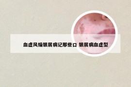 血虚风燥银屑病记那些口 银屑病血虚型