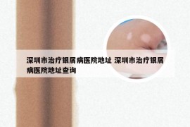 深圳市治疗银屑病医院地址 深圳市治疗银屑病医院地址查询