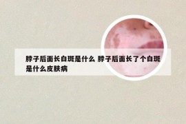 脖子后面长白斑是什么 脖子后面长了个白斑是什么皮肤病