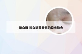 淡白斑 淡白斑是分散的没有融合