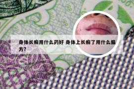 身体长癣用什么药好 身体上长癣了用什么偏方?