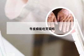牛皮癣能吃芡实吗