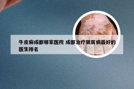 牛皮癣成都哪家医院 成都治疗银屑病最好的医生排名