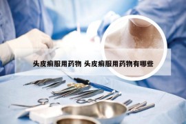 头皮癣服用药物 头皮癣服用药物有哪些
