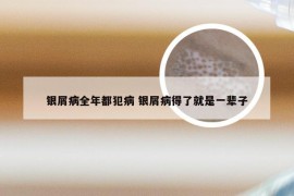 银屑病全年都犯病 银屑病得了就是一辈子