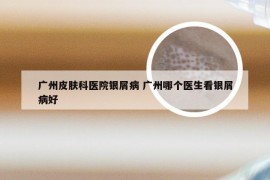 广州皮肤科医院银屑病 广州哪个医生看银屑病好