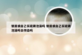 银屑病自己买硫磺泡澡吗 银屑病自己买硫磺泡澡吗会传染吗