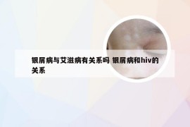 银屑病与艾滋病有关系吗 银屑病和hiv的关系
