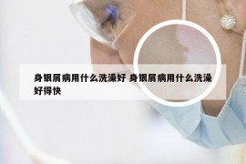 身银屑病用什么洗澡好 身银屑病用什么洗澡好得快
