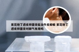 紫花地丁透皮抑菌膏能治牛皮癣嘛 紫花地丁透皮抑菌膏对脚气有用吗