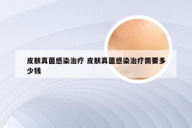 皮肤真菌感染治疗 皮肤真菌感染治疗需要多少钱