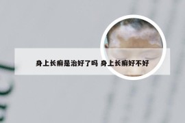 身上长癣是治好了吗 身上长癣好不好