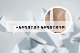 人起癣是什么样子 起癣是什么样子的