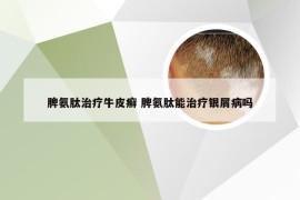 脾氨肽治疗牛皮癣 脾氨肽能治疗银屑病吗