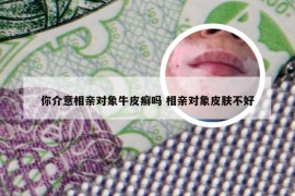 你介意相亲对象牛皮癣吗 相亲对象皮肤不好