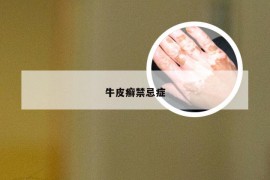 牛皮癣禁忌症