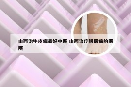 山西治牛皮癣最好中医 山西治疗银屑病的医院