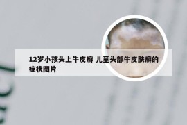 12岁小孩头上牛皮癣 儿童头部牛皮肤癣的症状图片