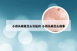 小孩头癣是怎么引起的 小孩头癣怎么回事
