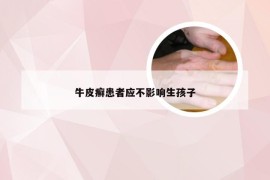 牛皮癣患者应不影响生孩子