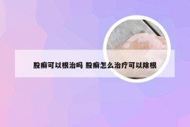 股癣可以根治吗 股癣怎么治疗可以除根