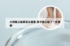 小孩腿上起癣怎么回事 孩子腿上起了一片像癣