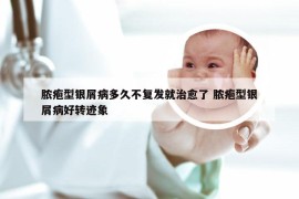 脓疱型银屑病多久不复发就治愈了 脓疱型银屑病好转迹象