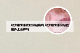 缺少维生素皮肤会起癣吗 缺少维生素会起疙瘩身上会痒吗