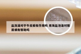 盐洗澡对于牛皮癣有作用吗 用海盐泡澡对银屑病有帮助吗