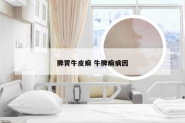 脾胃牛皮癣 牛脾癣病因
