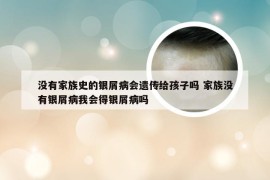 没有家族史的银屑病会遗传给孩子吗 家族没有银屑病我会得银屑病吗
