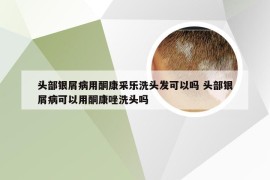 头部银屑病用酮康采乐洗头发可以吗 头部银屑病可以用酮康唑洗头吗