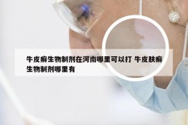 牛皮癣生物制剂在河南哪里可以打 牛皮肤癣生物制剂哪里有