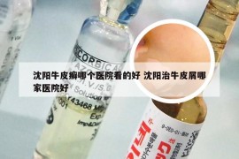 沈阳牛皮癣哪个医院看的好 沈阳治牛皮屑哪家医院好