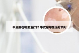 牛皮廨在哪里治疗好 牛皮廨哪里治疗的好