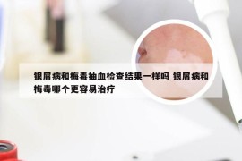 银屑病和梅毒抽血检查结果一样吗 银屑病和梅毒哪个更容易治疗