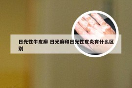 日光性牛皮癣 日光癣和日光性皮炎有什么区别