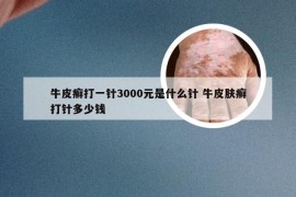 牛皮癣打一针3000元是什么针 牛皮肤癣打针多少钱