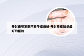 开封市哪家医院看牛皮癣好 开封看皮肤病最好的医院