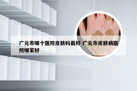 广元市哪个医院皮肤科最好 广元市皮肤病医院哪家好