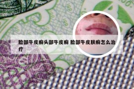 脸部牛皮癣头部牛皮癣 脸部牛皮肤癣怎么治疗