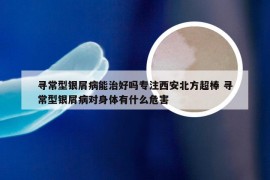 寻常型银屑病能治好吗专注西安北方超棒 寻常型银屑病对身体有什么危害