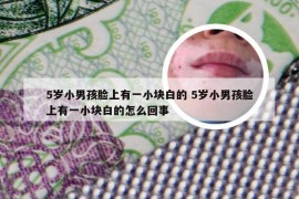 5岁小男孩脸上有一小块白的 5岁小男孩脸上有一小块白的怎么回事