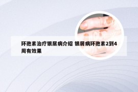 环孢素治疗银屑病介绍 银屑病环孢素2到4周有效果