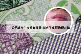 关于城市牛皮癣有哪些 城市牛皮鲜治理办法