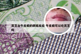 灵芝治牛皮癣的瞑眩反应 牛皮癣可以吃灵芝吗