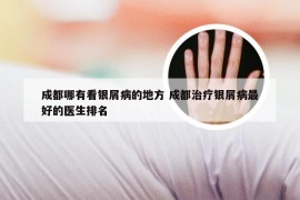 成都哪有看银屑病的地方 成都治疗银屑病最好的医生排名